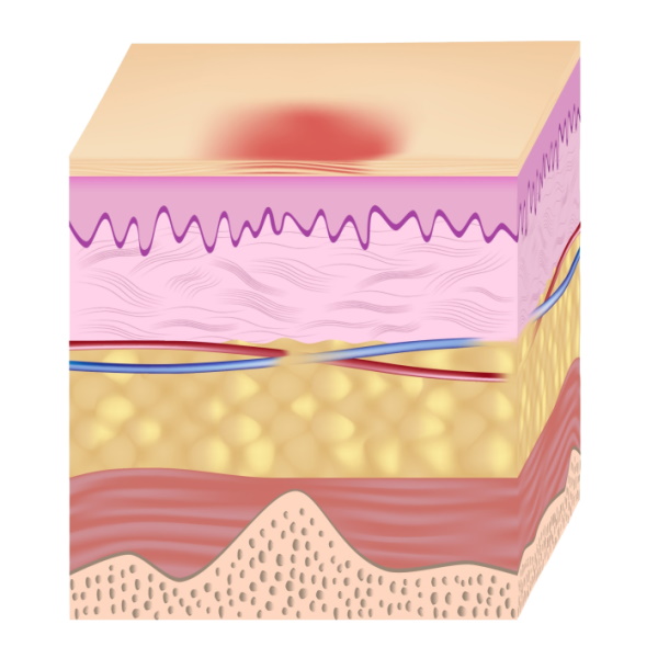 Pressure ulcer treatment